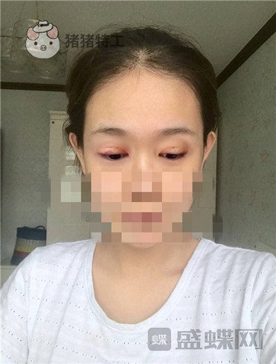 杭州美莱，韩超，双眼皮，案例，价格，