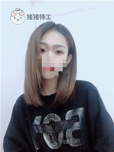 杭州美莱，韩超，双眼皮，案例，价格，