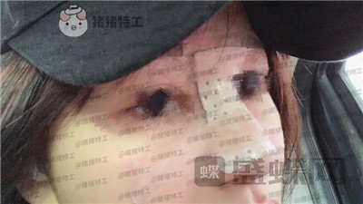 洛阳华美宋俊岭隆鼻案例价格