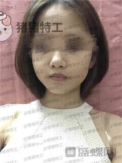 成都美容整形，李静，面部填充，案例，价格，