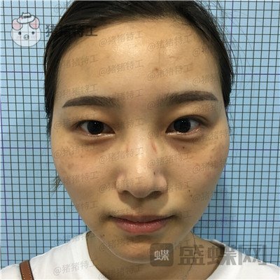 杭州格莱美，王馨婉，双眼皮，案例，价格，