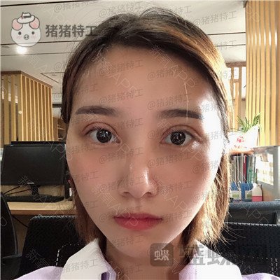 杭州格莱美，王馨婉，双眼皮，案例，价格，