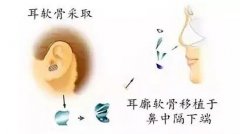 耳软骨和肋软骨隆鼻有什么区别？